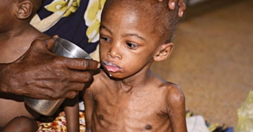 Beni : 4 cas de décès de malnutrition enregistrés dans l’aire de santé de Kangauka depuis le début de l’année 2022